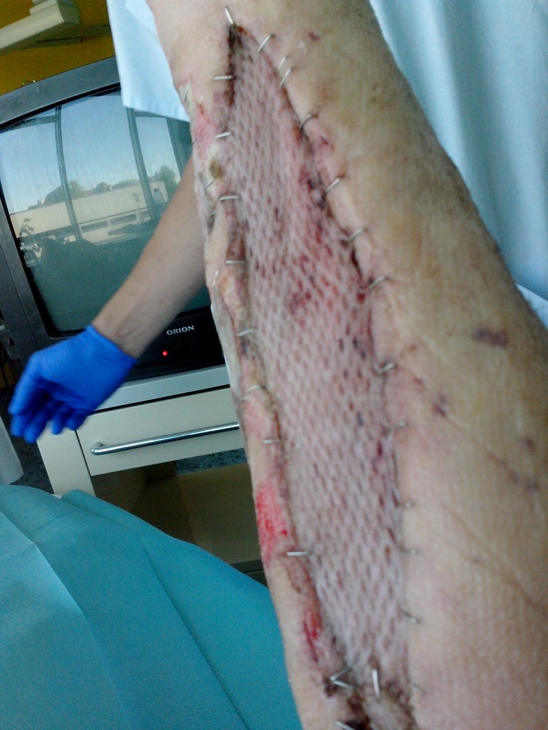 5 VV forearm transplant