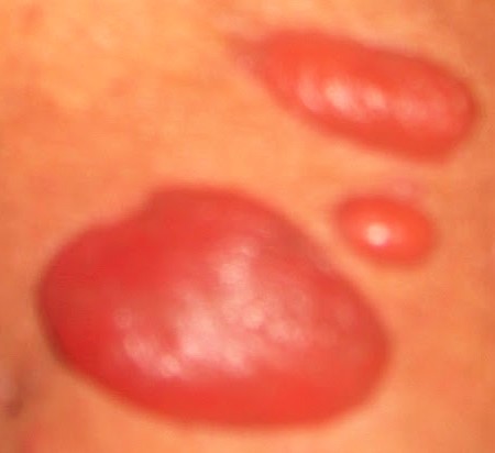 vibrio blisters3